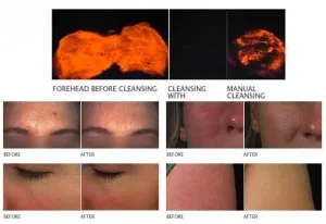 before and after of the clarisonic