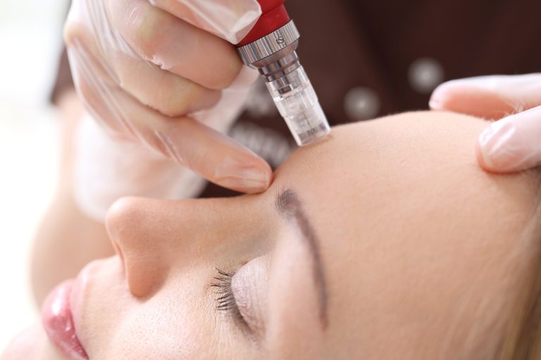 collagen induction therapy