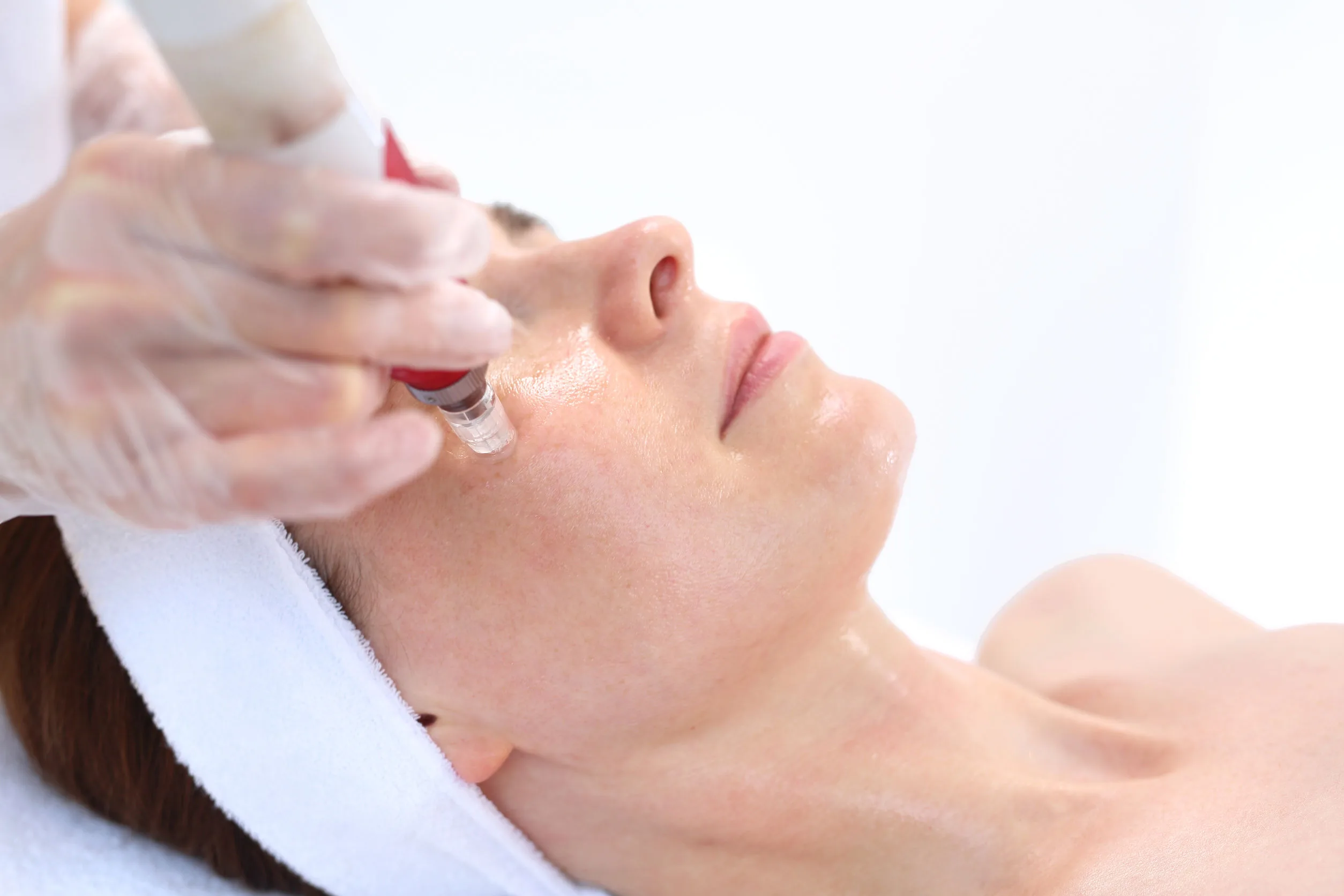 Collagen Induction Therapy: The Other Name for Micro Needling