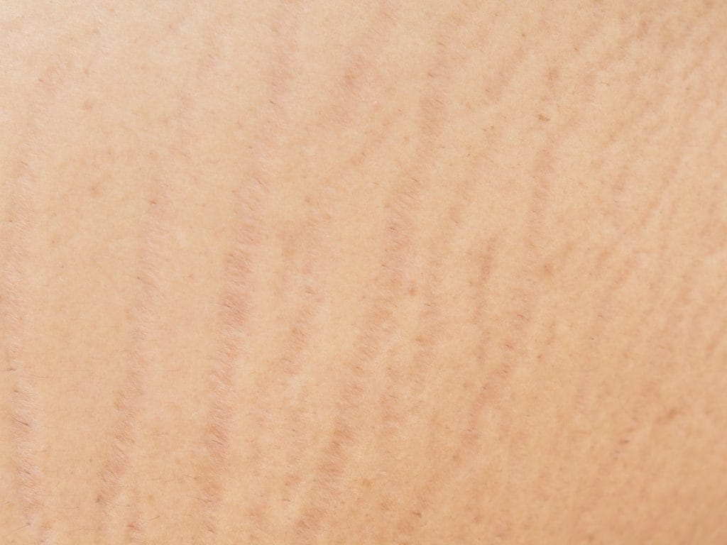 How to reduce stretch marks with micro needling botanica day spa