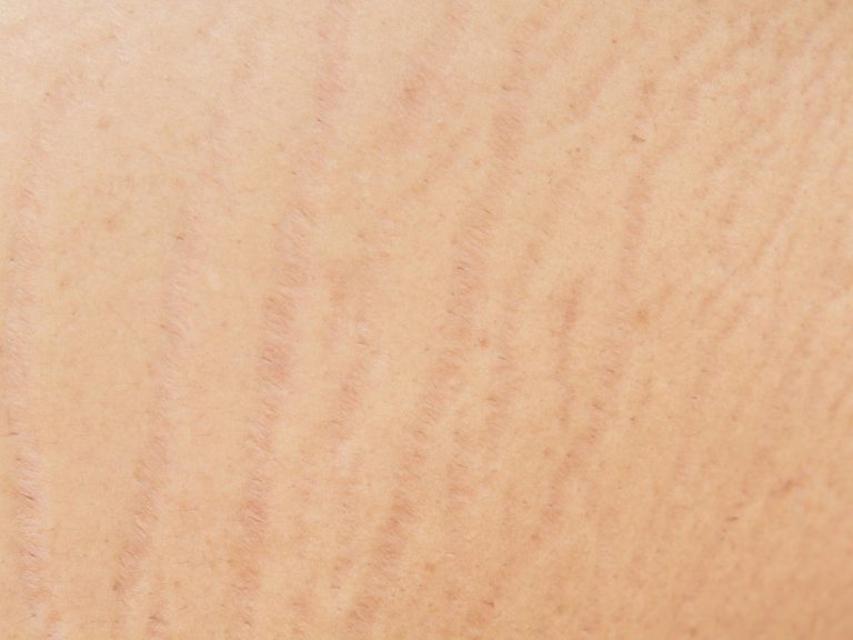 how to reduce stretch marks