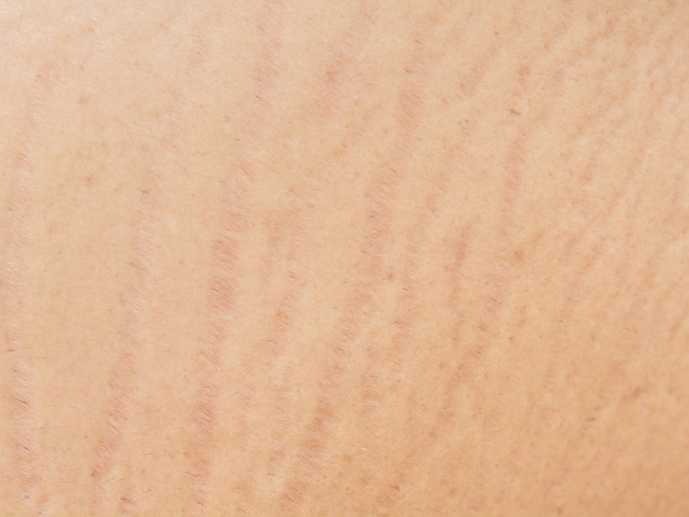 how to reduce stretch marks