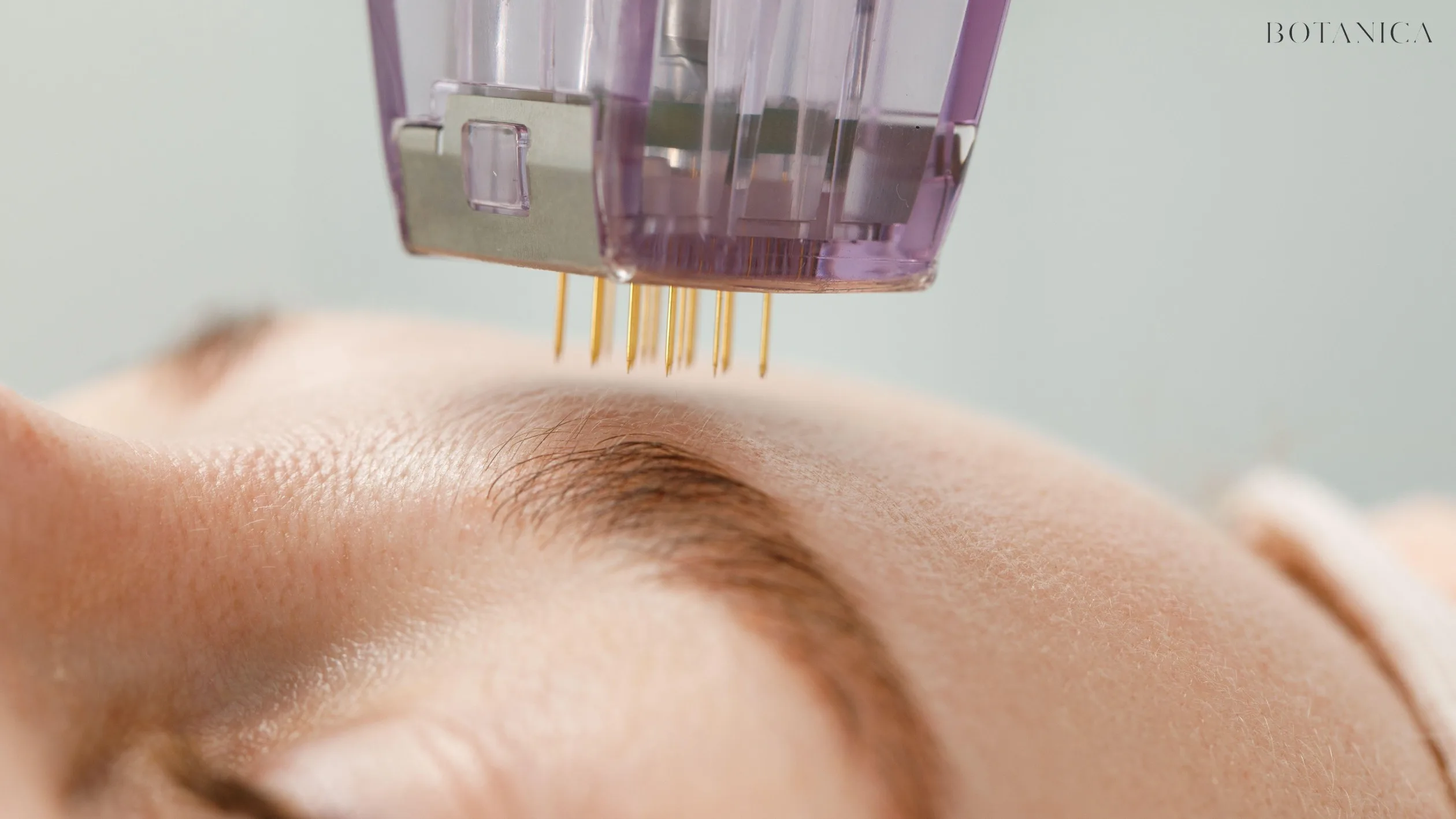 At Home Microneedling vs Professional Microneedling 